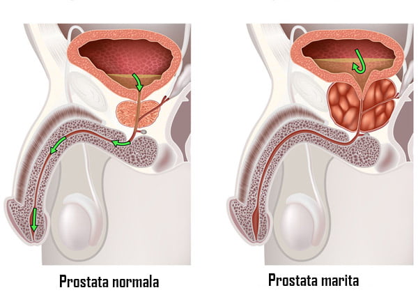 reabilitare după prostatită hiperplasia benigna de próstata gpc