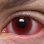 remedii naturiste pentru salazion