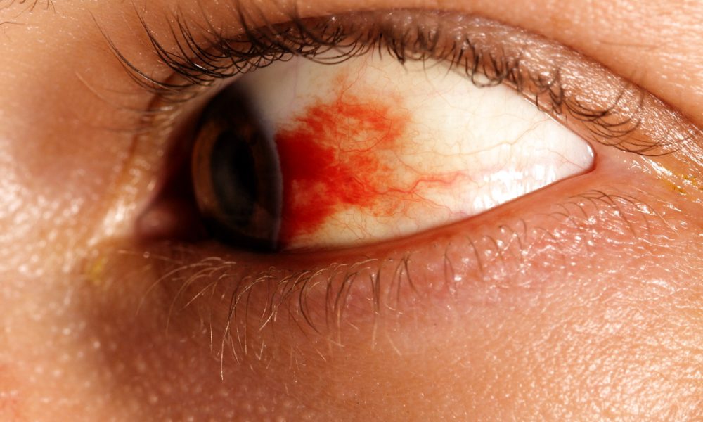 pata de sange pe albul ochilor hemoragia subconjunctivala