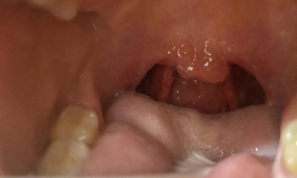 Cum se tratează uvula umflată (omulețul mărit)? Ghid Complet pentru Tratament și Vindecare Rapidă