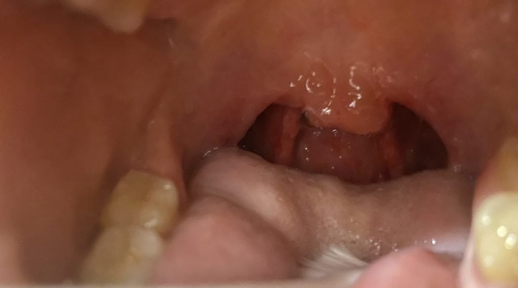 Cum se tratează uvula umflată (omulețul mărit)? Ghid Complet pentru Tratament și Vindecare Rapidă