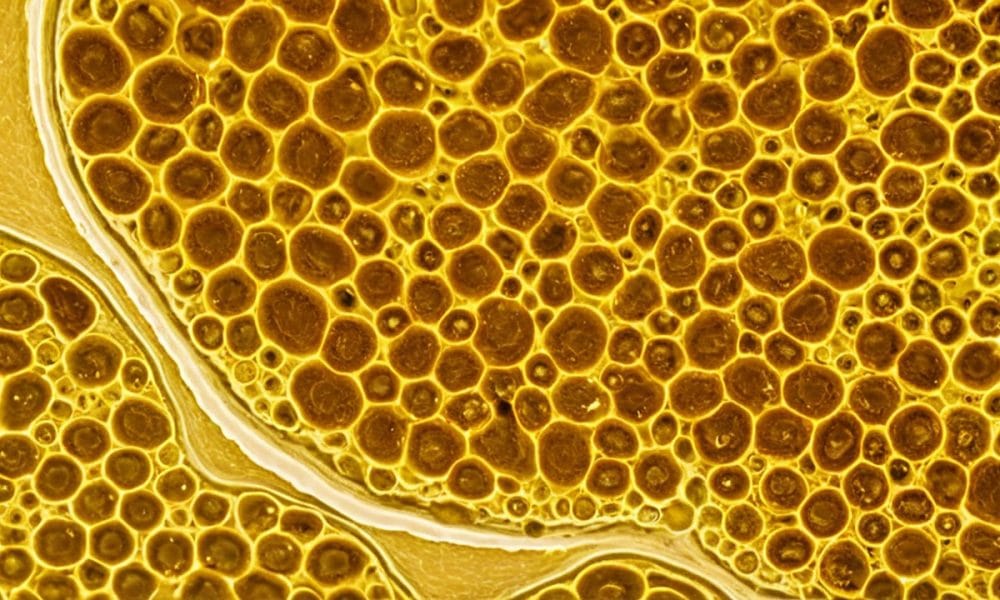 celule epiteliale scumoase in urina