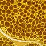 celule epiteliale scumoase in urina