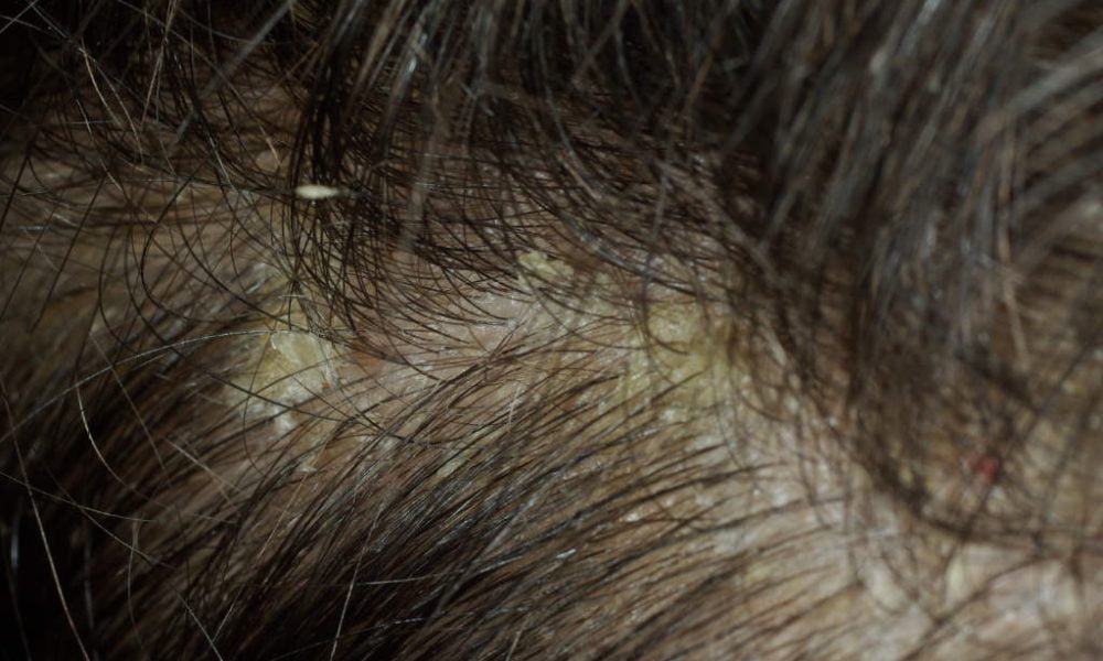 Cum scapi de mătreață cu busuioc? diferenta dintre lindini si matreata