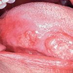 Cautati un profesionist in constructii pe REFORMEX si beneficiati de rezultate perfecte! cancer pe limba