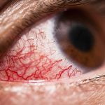 pete rosii in ochi si vase de sange