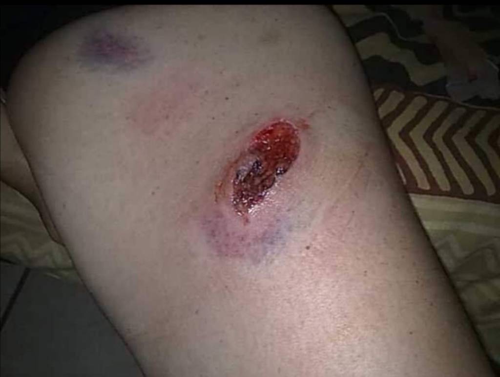 de ce miroase urat rana infectie