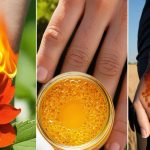 Cele Mai Eficiente Remedii Naturiste pentru Arsurile Termice, Chimice și Solare: Ghidul Detaliat de Tratament Complementar