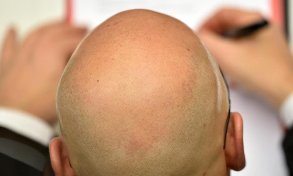 Cum afli dacă o să chelești?