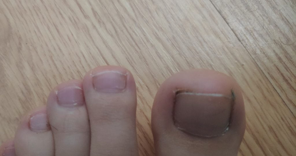 Cum se tratează unghiile încarnate cu uleiuri esențiale?