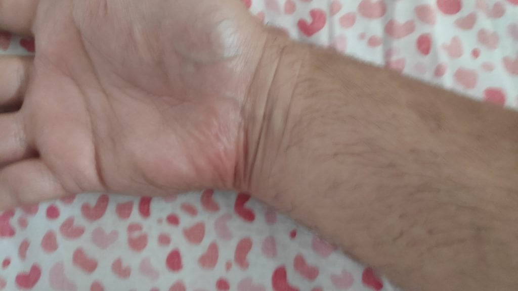 Care sunt cele mai bune antiinflamatoare naturale pentru tendinită?