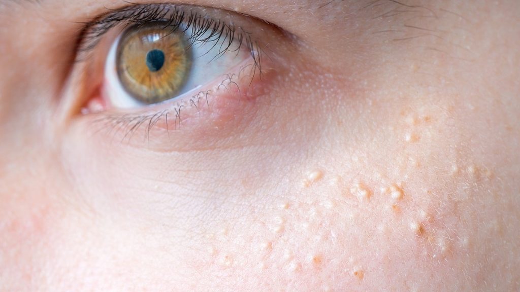 Ce este milia și cum să scăpați de ea?