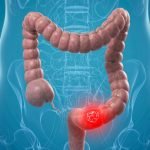 Unde doare colonul în funcție de fiecare boală în parte?