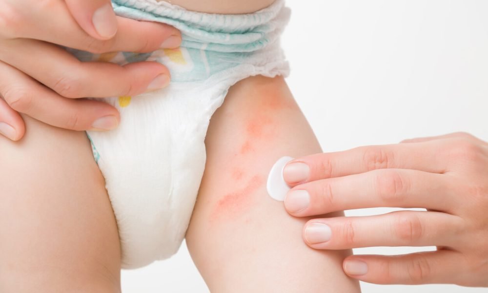 cauzele aparitiei acneei si a cosurilor pe organele genitale ale bebelusilor si copiilor