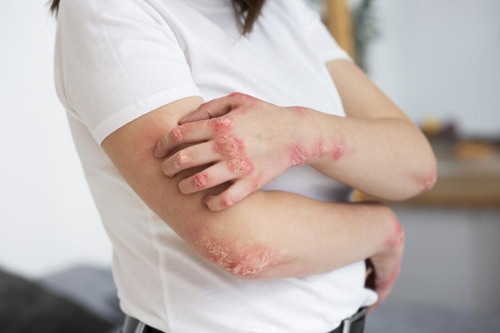 diata vindeca psoriazisul