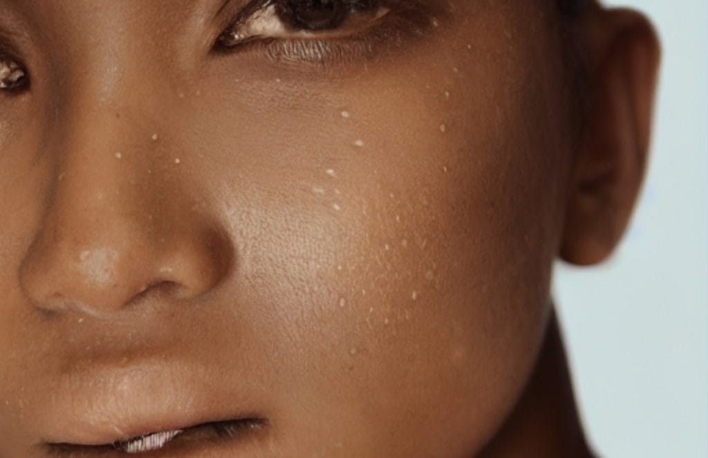 Cum se elimina punctele Fordyce cu solutii eficiente