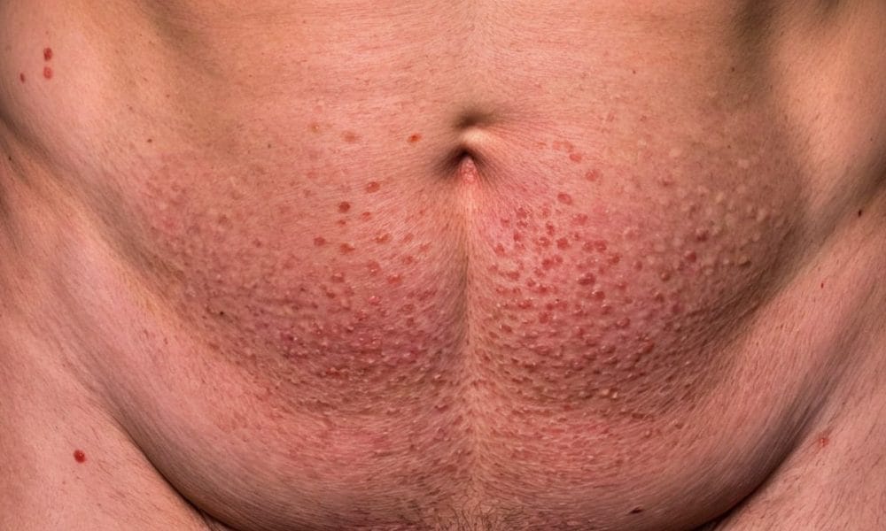 Unde Apare Zona Zoster: Ghidul Complet Despre Locația, Simptomele și Tratamentul Herpesului Zoster unde apare zona zoster